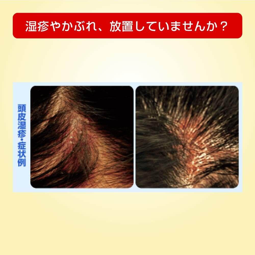 Mentholatum Medi Quick H Gold for Scalp (Sponge) - imy Shop Japan